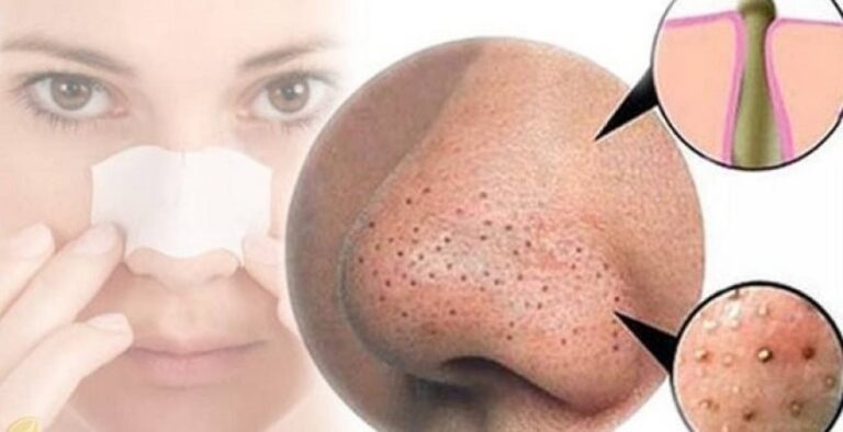 cach-tri-mun-dau-den